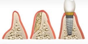 ac4e3ccd Qual Cor dos Dentes é Ideal para Lentes e Coroas de Porcelana ?