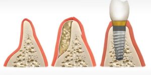 defeito_osseo_enxerto_implante_50kb Tratamento de estética dental antes e depois