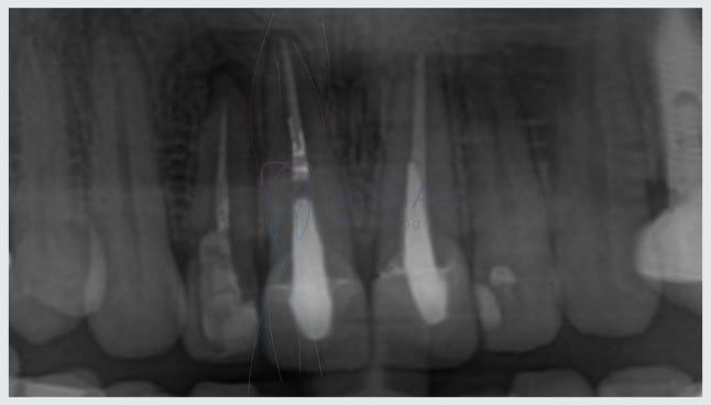 ad019993 O que fazer quando surge uma cárie dentária?