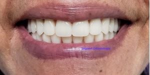 af6b806c Por que trocar sua prótese fixa sobre dentes por implante com coroa?