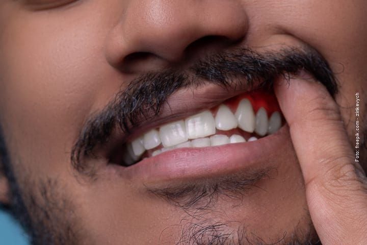 ardor_gengiva_irritada_49kb-afb353d1 Sonhar Com Dente Caindo Ou Quebrado