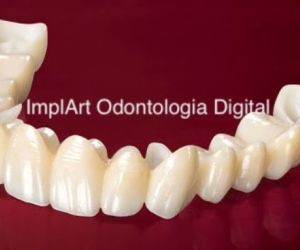 b0ea8719 Recuperação de um implante dentário: quanto tempo?
