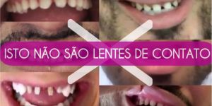 b118a95b Restaurando Sorrisos com Precisão: Implante Dentário Parcial na Clínica ImplArt