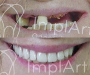b4493eb2 Implante dentário em quem usa aparelho ortodôntico