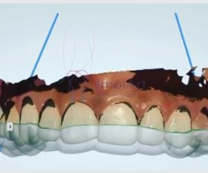 ba33e1af Complicações / erros e falhas em implantes dentários