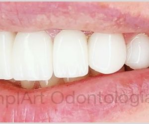 bc7f22fe Projeto de prótese dentária em 3D