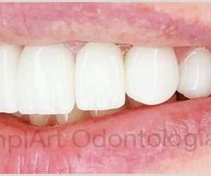 coroas_de_porcelana_lente_de_contato_dental_40kb-bc7f22fe Tratamento dentário rápido em São Paulo