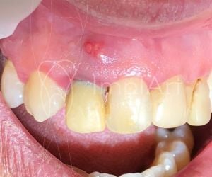 fistula_dental_49kb-bd8c57fc Antibióticos na Infância e Riscos Dentários