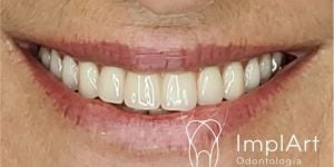 be81becb Dentes de tubarão: imagens divulgadas na internet como lentes dentais, mas não são.