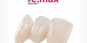 c0b3af3a Implantes dentário antes e depois