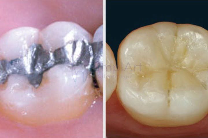 c54d320e Restaurações metálicas: quando substituir por porcelana ou resina?