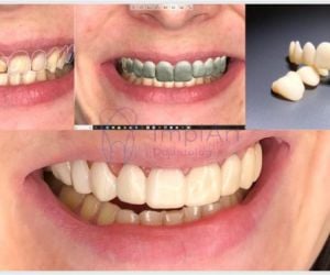 c638aa71 Enxerto ósseo biomolecular para implante