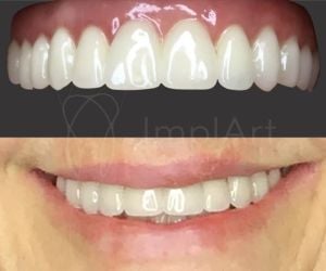 c6a37e03 Epilepsia e a Odontologia: tratamento dental e implante dentário