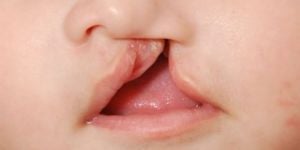 labio-leporino-agenesia-4-c645b505 Implante dental: prótese provisória ajuda na estética final