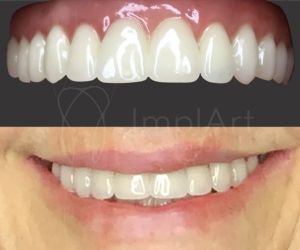 protese_zirconia_porcelana_implante_50kb-c6a37e03 Projeto de prótese dentária em 3D