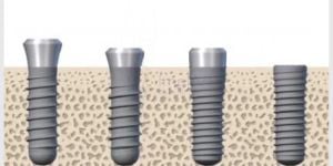 implante_osseointegracao_25kb-c7753b15 Implantes dentário antes e depois