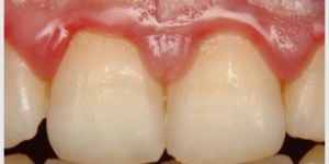 bolsa_periodontal_25kb-cca5ad9c O bruxismo causa desgaste nos dentes