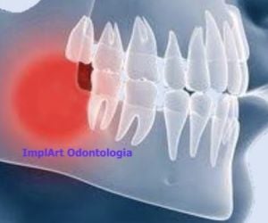 cca956f7 Prótese dentária de porcelana ou de resina?