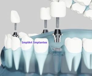 cd03c4d3 Rejeição de implante dentário: pode ocorrer?