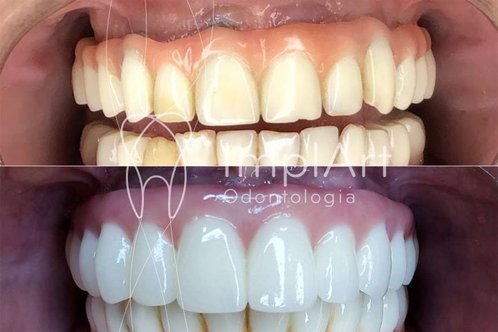 protese_total_fixa_em_zirconia_implante_antes_e_depois_50kb-cdcae57e Troque a prótese protocolo de resina por prótese de porcelana ou zircônia
