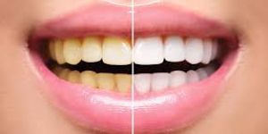 cfd896b8 Parestesia depois de uma cirurgia de implante dentário