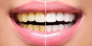 clareamento-dental-cfd896b8 Moldagem computadorizada com Scanner Intraoral