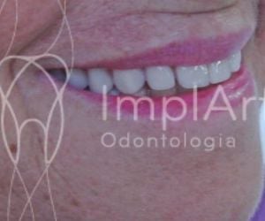 d15acf3d Por que trocar sua prótese fixa sobre dentes por implante com coroa?