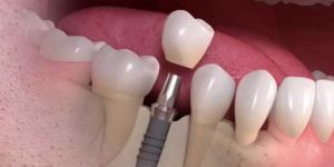 d1b9d6e4 Lentes de contato dentais para fechamento de diastemas