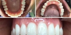 protese_total_resina_fixa_implantes_49kb-d14e9f96 Especialista em implantes dentarios - Implantodontista Dr. Roberto Markarian