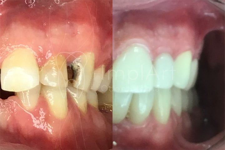 restauracao_dente_com_carie_50kb-d12f7d7a Antibióticos na Infância e Riscos Dentários