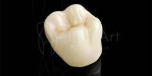 coroa_zirconia_estetica_cerec_50kb-d2a79132 Cirurgia de implante guiada (fechada) ou cirurgia aberta
