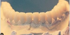 d21ef3e2 O implante dentário x doenças sistêmicas comuns