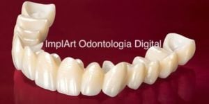 protese_fixa_zirconia_50kb-d274bdd5 Implantes Straumann são os mais rápidos