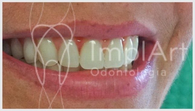 d5faae47 Prótese protocolo de resina com estrutura de titânio