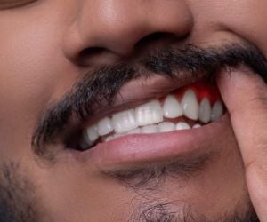 ardor_gengiva_irritada_49kb-d7709649 Sedação odontológica: tratamento dentário para odontofobia