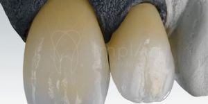 zirconia_cubica_translucida_fx_50kb-d7d58559 Enxerto ósseo biomolecular para implante