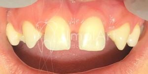 d817f305 Lábio leporino e implantes dentários para substituir dentes