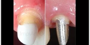 nucleo_estetico_x_nucleo_metalico_30kb-d9ff7cc9 O que é zircônia dental? E porque é o melhor material ?
