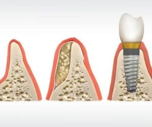 da142fb2 Recuperação de um implante dentário: quanto tempo?