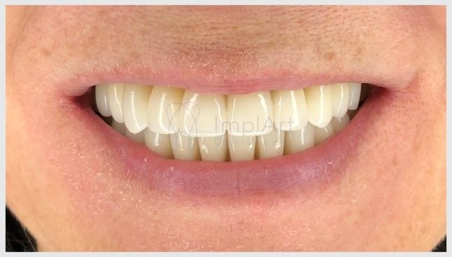 zirconia_protese_total-dd7d1de8 Prótese de zircônia dental computadorizada para arcada total