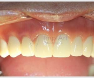 dfc77759 Implantes dentários: alimentação e cuidados após a cirurgia