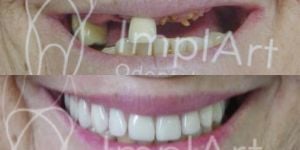 e0beca82 Vídeo: cirurgia de implante dentário