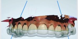 e289ac8e Botox para ATM - tratamento da articulação da boca