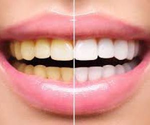 clareamento-dental-e42fea6c Prótese protocolo de resina com estrutura de titânio