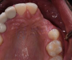 perda_ossea_falta_dentes_50kb-e4fc565e Antibióticos na Infância e Riscos Dentários