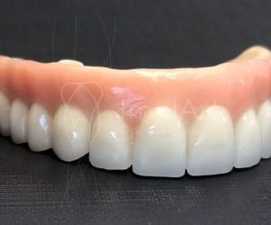 e5cd9712 Implantes dentários: alimentação e cuidados após a cirurgia