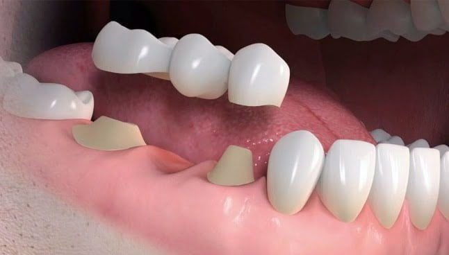 ponte_fixa_sobre_dente_50kb-e77948e8 Não quero fazer implante dentário, como posso repor um dente?