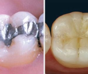 e8f44957 O que fazer quando surge uma cárie dentária?