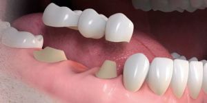 e90806e4 Depressão emocional afeta a saúde bucal e os dentes?
