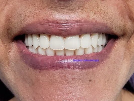 e949351f Implante de Três Dentes Juntos - Como fazer ?